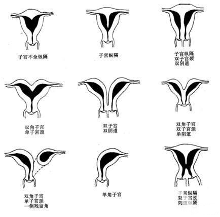 子宮畸形患者可以做試管嬰兒?jiǎn)幔? /></a>
					<div   id=