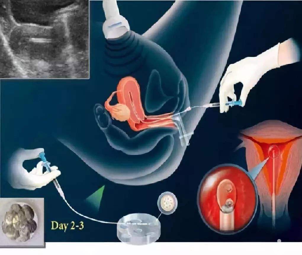 試管嬰兒移植后出血正常嗎？