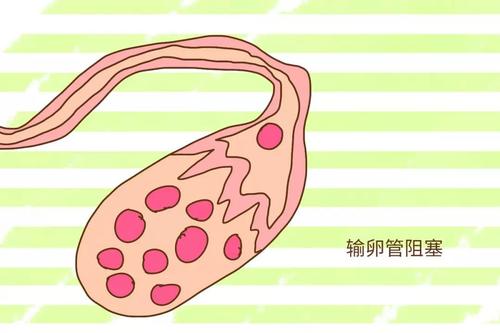 你可能還不夠了解輸卵管為什么會(huì)堵塞！