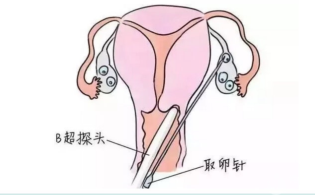 做試管嬰兒時，取卵越多越好嗎？