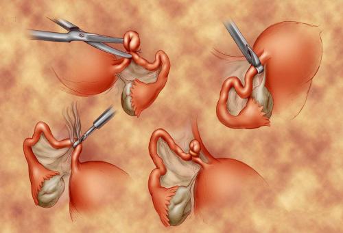 已經(jīng)做過(guò)結(jié)扎手術(shù)，是否可以繼續(xù)做試管嬰兒？