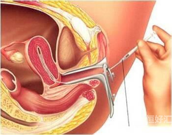 人工授精技術(shù)，你真的了解嗎？