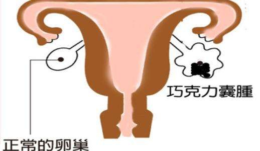 巧克力囊腫，是怎么回事呢？