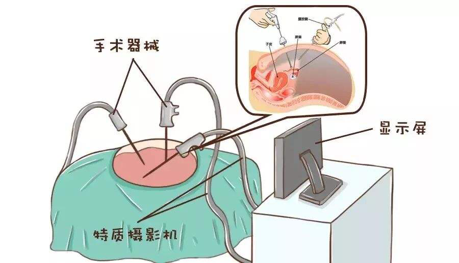 什么人適合腹腔鏡檢查呢？