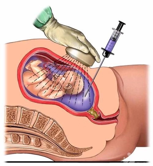 孕婦做羊水檢查，需要注意什么嗎？