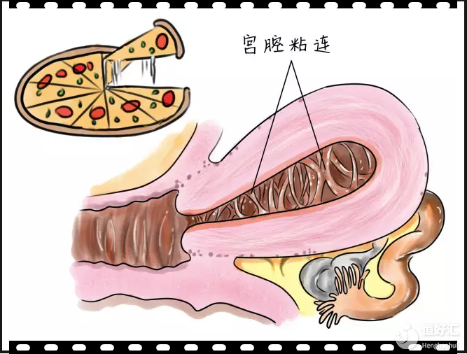 當輸卵管堵塞遇到宮腔粘連，試管嬰兒還救得了嗎？