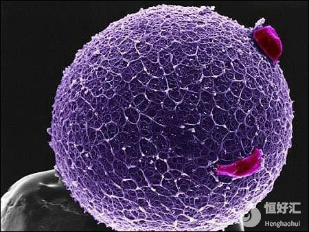 卵巢過(guò)度刺激綜合征，到了中重度怎么辦？