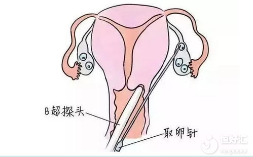 試管嬰兒取卵后，你很有必要注意6大件事情！