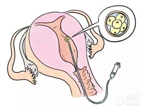 做試管嬰兒“我”要怎樣避免宮外孕？