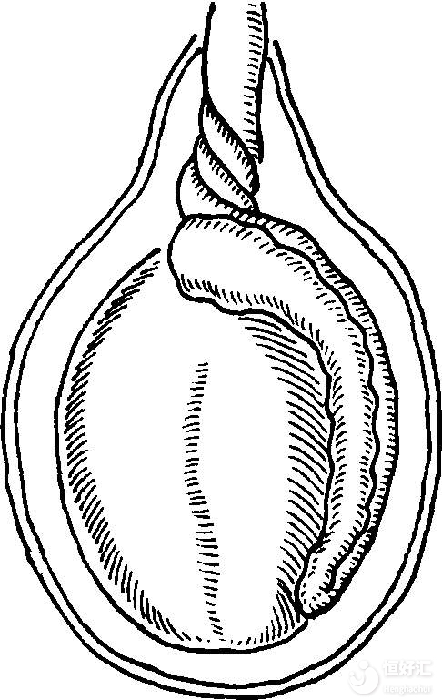 急！睪丸扭轉(zhuǎn)可以自救嗎？怎么辦？在線等......