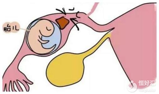 輸卵管妊娠一定是宮外孕嗎？