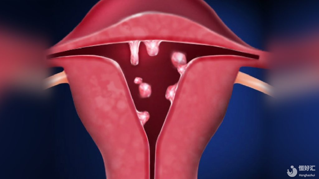 子宮息肉對(duì)試管嬰兒成功率的影響，別不重視！