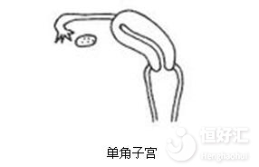 單角子宮能否做試管嬰兒？成功率有多高？