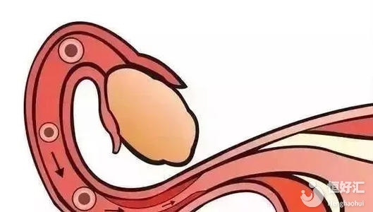 輸卵管堵塞一定要做試管嬰兒？專家：謠言