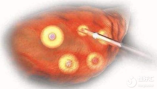 試管嬰兒取卵會影響女性健康？這些知識你得知道