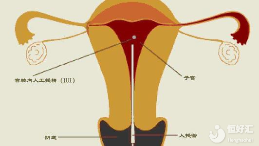 人工授精疼嗎？過來人說的這番話很震驚！