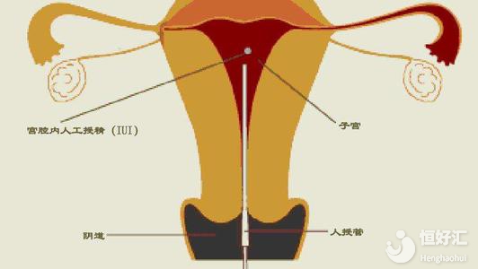 供精人工授精流程揭秘，你不知道的還有這幾點！