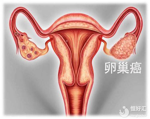 做試管嬰兒容易得卵巢癌嗎？醫(yī)生：事實(shí)擺在這