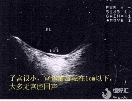 幼稚子宮能做試管嬰兒嗎？醫(yī)生提醒你這樣做