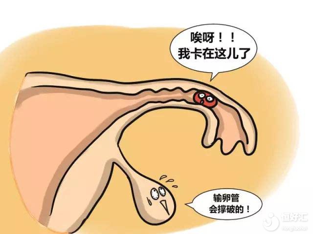 原來你的不孕癥是因為積水？那你知道為什么嗎？