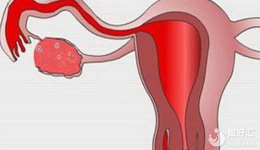 不常見的生殖器官結(jié)核病，可導(dǎo)致不孕？
