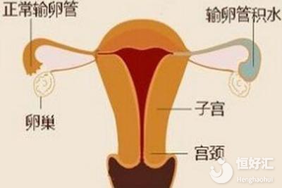 子宮異常不會影響試管嬰兒？請看完這個再下定論