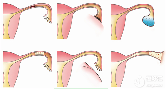 輸卵管堵塞請做好這些檢查，有需要的妹子看過來！