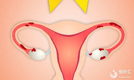 吃藥VS試管嬰兒？多囊患者想要寶寶該如何選擇