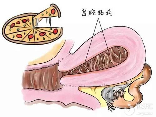 宮腔粘連，就不能懷孕了？醫(yī)生稱視情況而定！