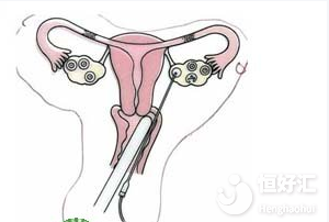 關于試管嬰兒取卵那些事兒，你了解了多少？