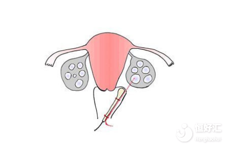 取卵怎么做？一分鐘帶你了解！