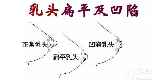 乳頭內(nèi)陷如何喂奶？這些方法希望能幫到你