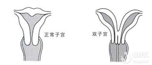 注意！子宮畸形正危及你的 “好孕”?！